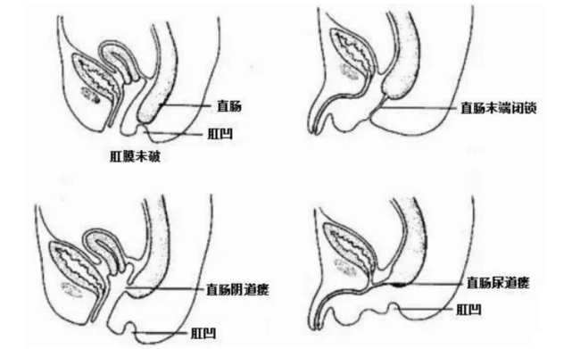 女性生殖道瘘图片