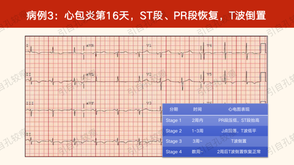 快速識別急性心包炎患者心電圖67(ppt)_騰訊新聞