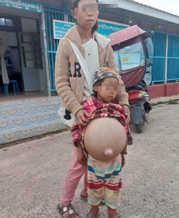 缅北贵慨一名儿童患大肚病肚子比身子大急需帮助