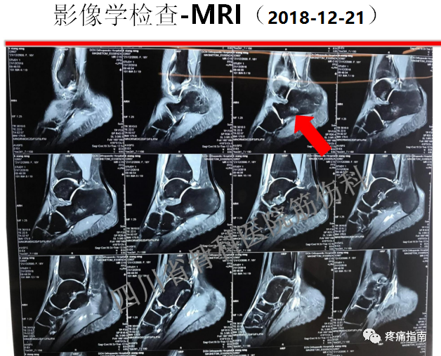 1例運動員跟骨骨髓水腫病例討論|骨髓水腫|踝關節|電針|跟骨