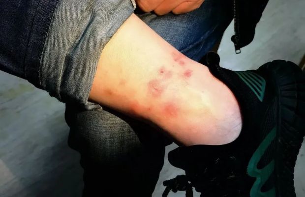 宁波男孩脚肿成馒头近期高发有医院一上午接诊十多例
