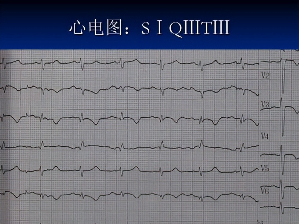 以前是完全正常的心电图,现在的心电图是:s1q3t3,结合患者血压较前