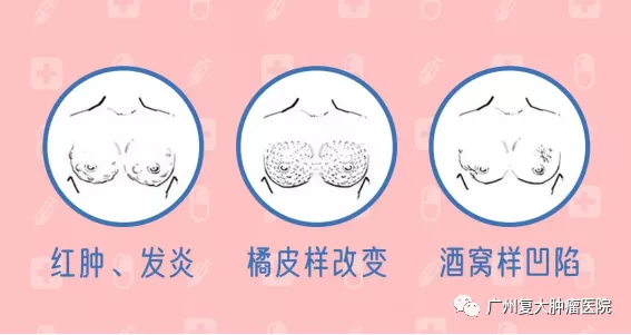 濟南腫瘤醫院請選擇廣州復大腫瘤醫院乳腺癌的微創保乳治療