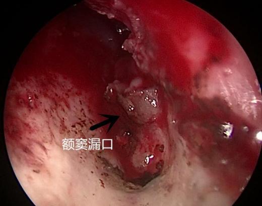 多学科联合为患者解除脑脊液鼻漏困扰