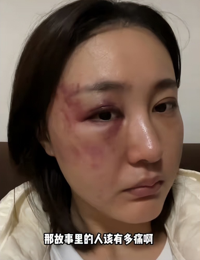 34岁女星遭家暴后现身派出所打到眼出血被鉴定轻伤老公已拘留