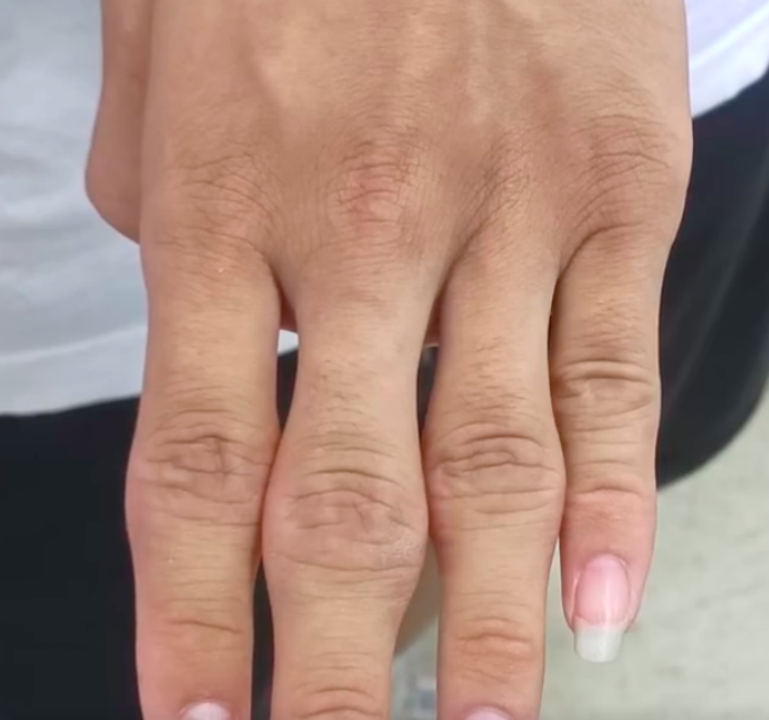 15岁男孩爱掰手指致双手变形医生他经常和同学比较谁掰手指的声音大