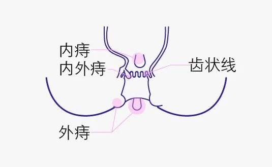 内痔疮长什么样子?