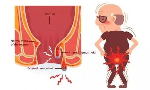 痔瘡是長什麼樣子的?
