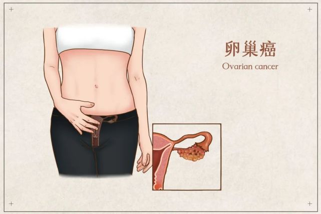 女性反覆腹脹 需防卵巢癌