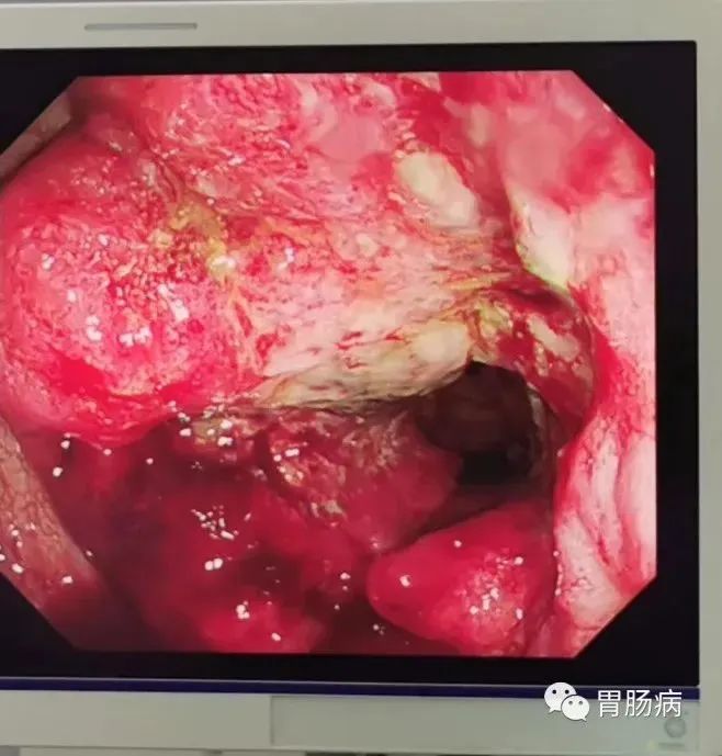 88的直肠癌曾被当成痔疮这种悲剧仍在天天上演专家提醒肠癌来临可能有