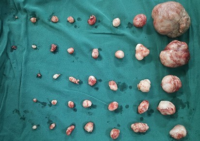 健康科普关于子宫肌瘤的那些事