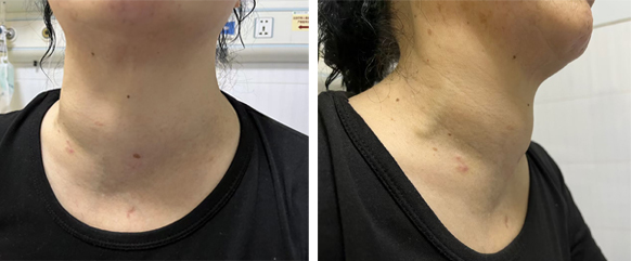 隐约觉得喉咙有异物感,吞咽不适,活动久了便呼吸不畅,脖子也越来越粗