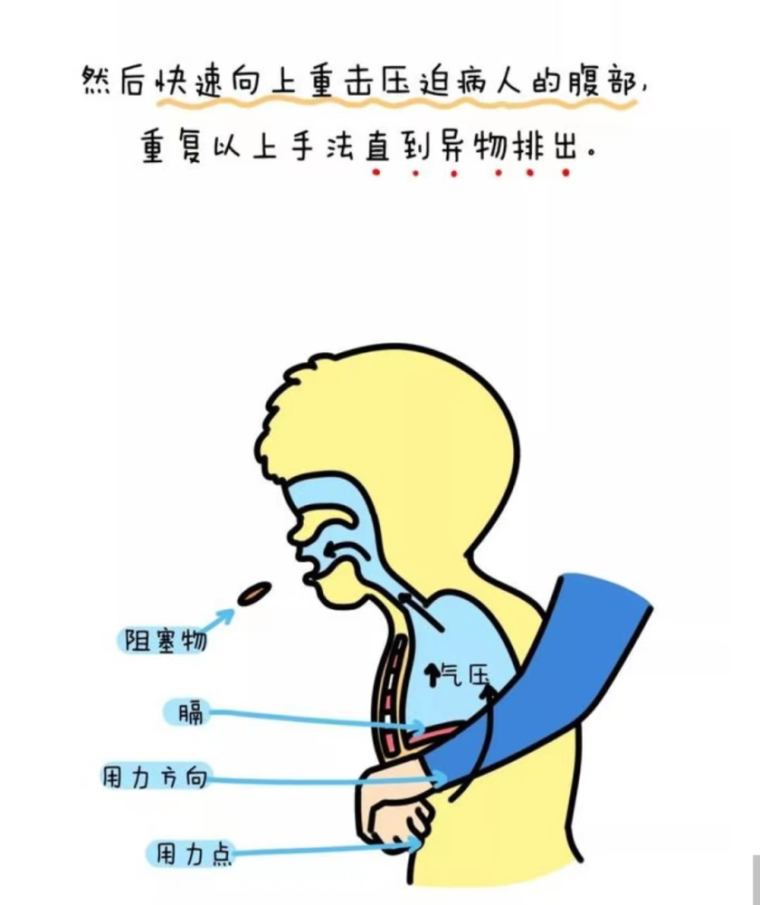 异物卡喉如何急救