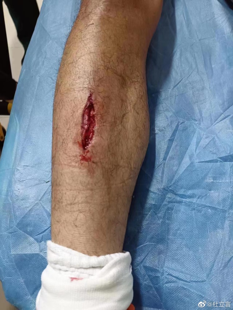 难怪李金羽生气武汉长江许东腿部被缝合12针中超首阶段基本报销