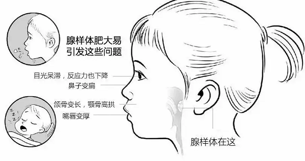 直樂大講堂:有這些症狀可能是腺樣體肥大 久拖不治會形成