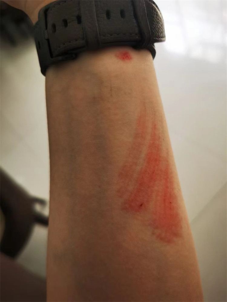 一夜连救2人手臂受伤,民警:领了个"勋章"_腾讯新闻