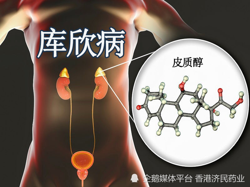 多個研究數據加強了isturisa在庫欣病患者中的療效及安全性