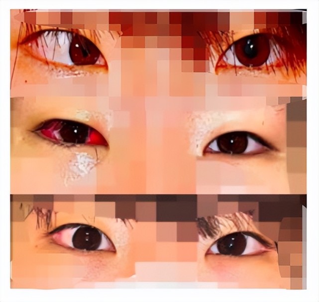 术后1天,术后3个月手术后三个月,默默的右眼红肿已经恢复正常,外观的