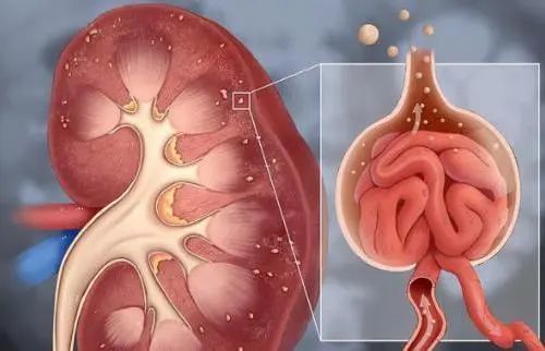 慢性腎炎一般是指慢性腎小球腎炎,是指病程超過三個月,慢性腎小球腎炎