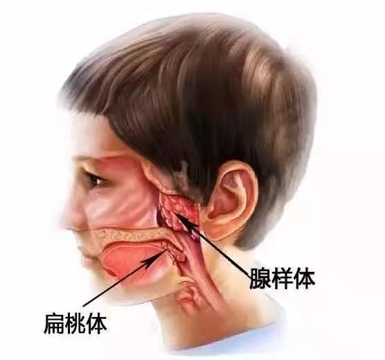 2,扁桃体肥大,影响正常呼吸,妨碍吞咽,导致说话不清等;1,扁桃体反复