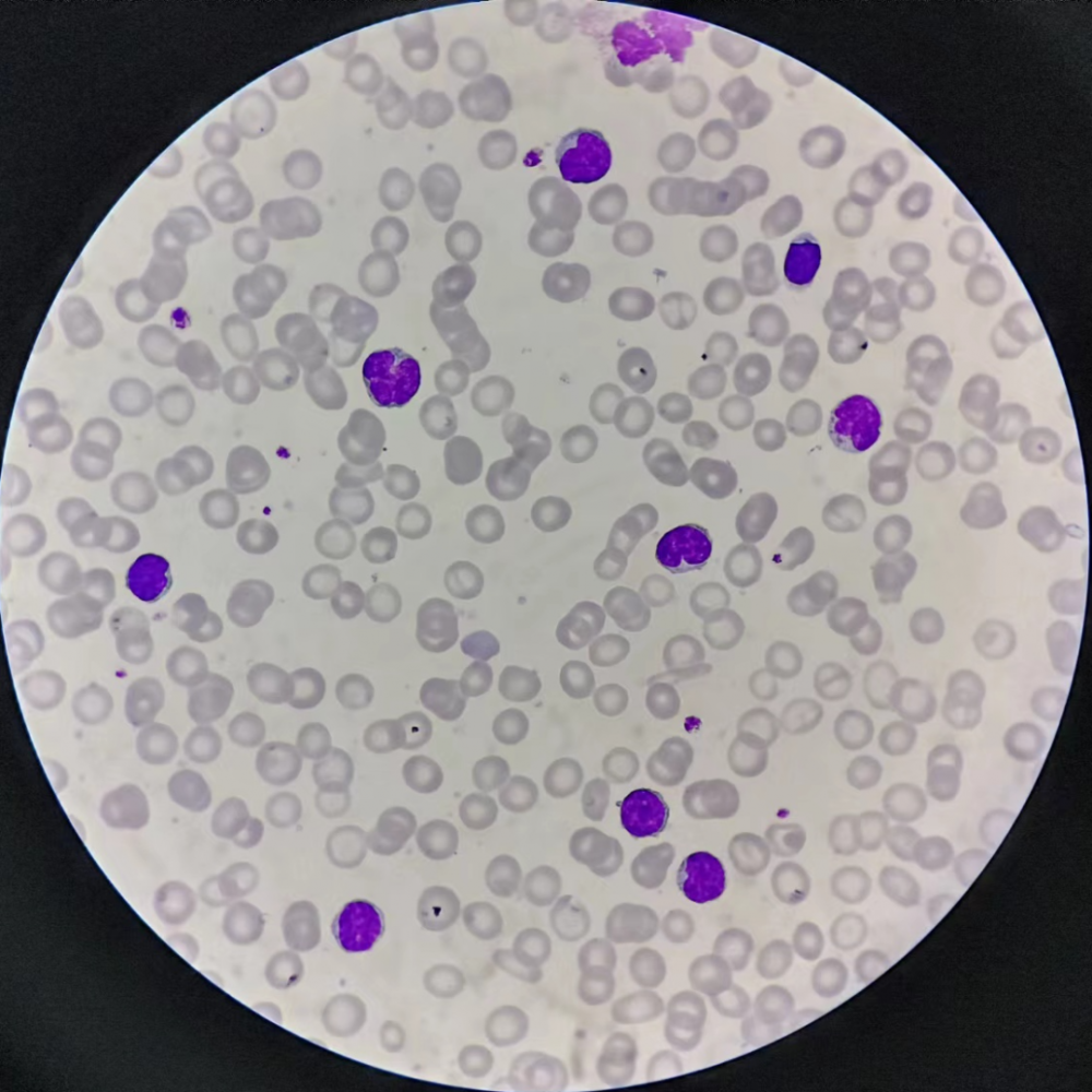 六天不见,淋巴细胞竟然换了一副面孔