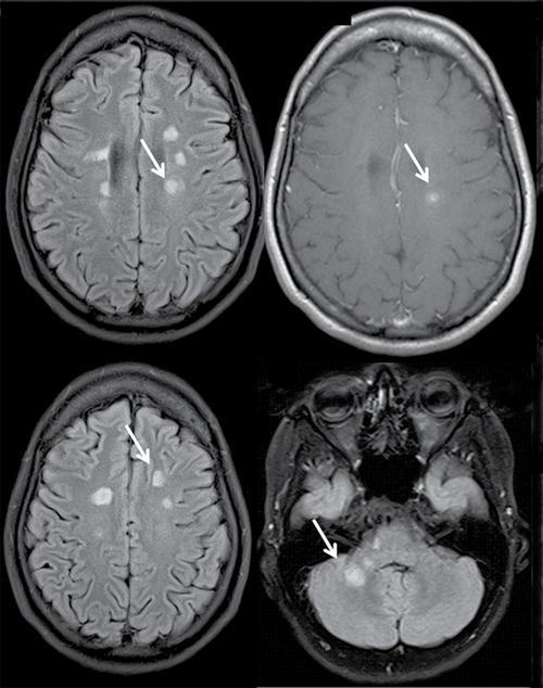 健步清言饮恢复好了多发性硬化_腾讯新闻