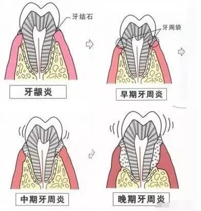 沒有患牙周炎的人完全可以通過普通洗牙就能去淨結石,即便是齦下有