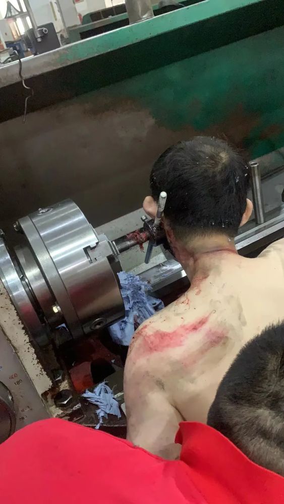 胆小慎入温州某车间发生事故工人脸颊被击穿