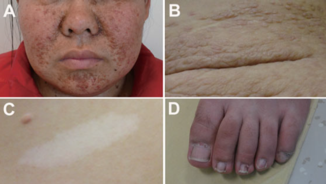 徐凯峰教授:弥漫性囊性肺疾病需重点关注这些"相对常见"的病因,获得