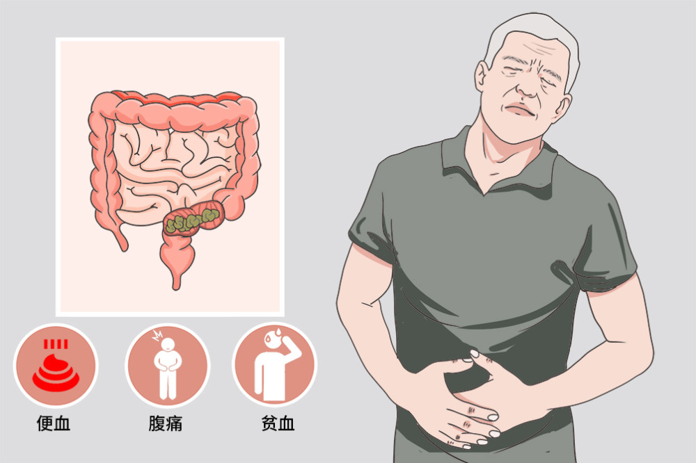 65歲男子便血5個月以為是痔瘡犯了結果竟是患上了直腸癌