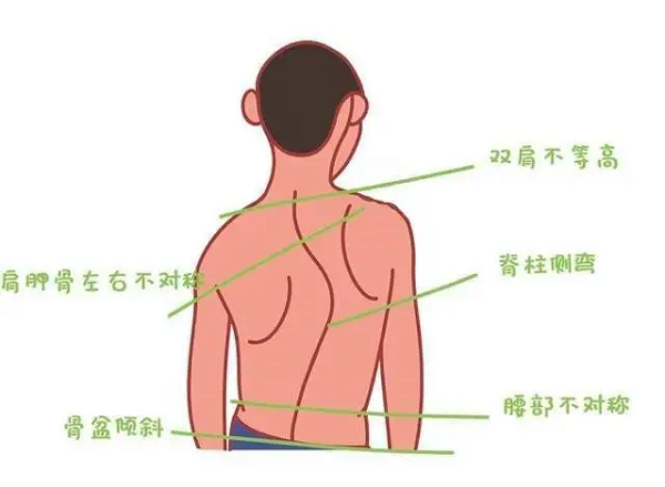 直樂大講堂歪脖子體態差警惕脊柱側彎