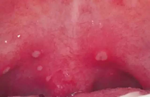 据悉,疱疹性咽峡炎口腔疱疹在初期主要是咽部充血,并有散在灰白色疱疹