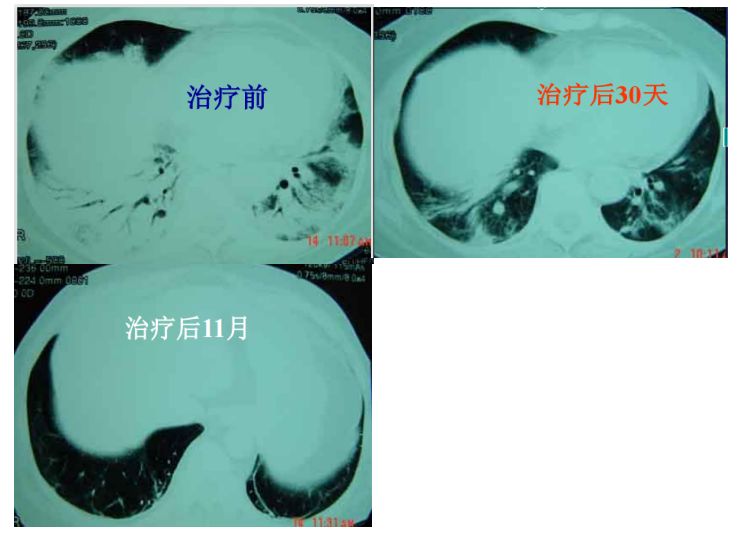 影像表現如圖 3:甲強龍治療方案:起始劑量: 160 mg/bid,iv(3d);120 mg