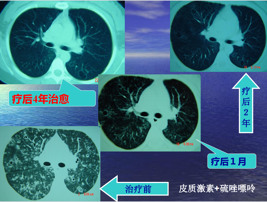 李惠萍教授糖皮質激素治療間質性肺疾病何時用多大量怎麼停cacp2022