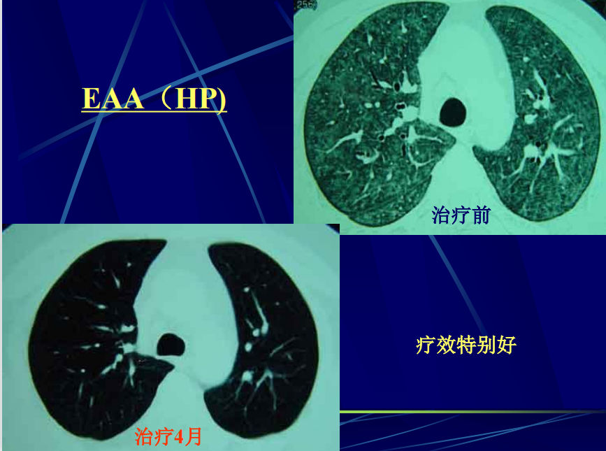 李惠萍教授糖皮質激素治療間質性肺疾病何時用多大量怎麼停cacp2022