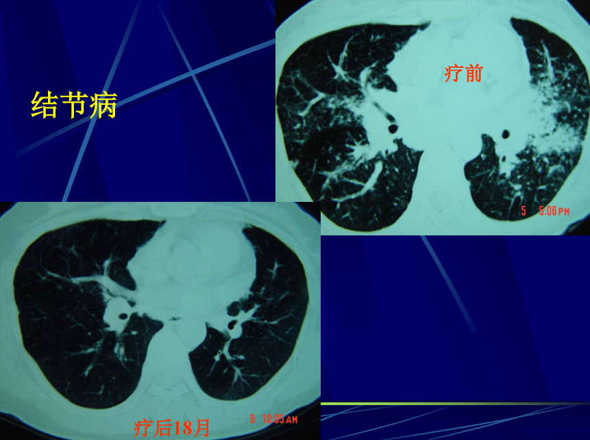 李惠萍教授糖皮質激素治療間質性肺疾病何時用多大量怎麼停cacp2022