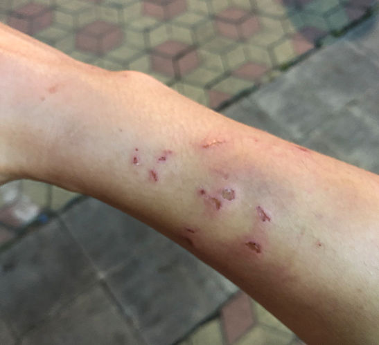 小伙遭女友抓咬身体多处受伤律师不算家暴但殴打他人违法