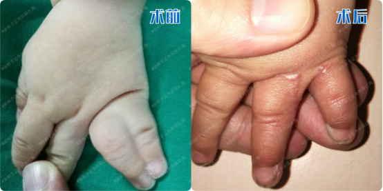 孩子手脚并指粘连严重曾做过三次手术母亲赴汉只为挽救孩子手脚