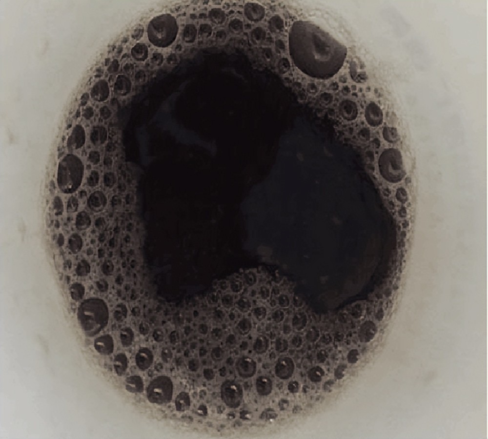 耳朵变蓝,眼睛变褐,脸颊变蓝,原来这就是罕见的"黑尿病"_腾讯新闻