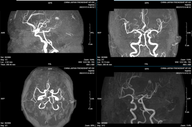 老年性腦改變;腦動脈輕度硬化改變頭顱mri:右側半卵圓中心;小缺血灶