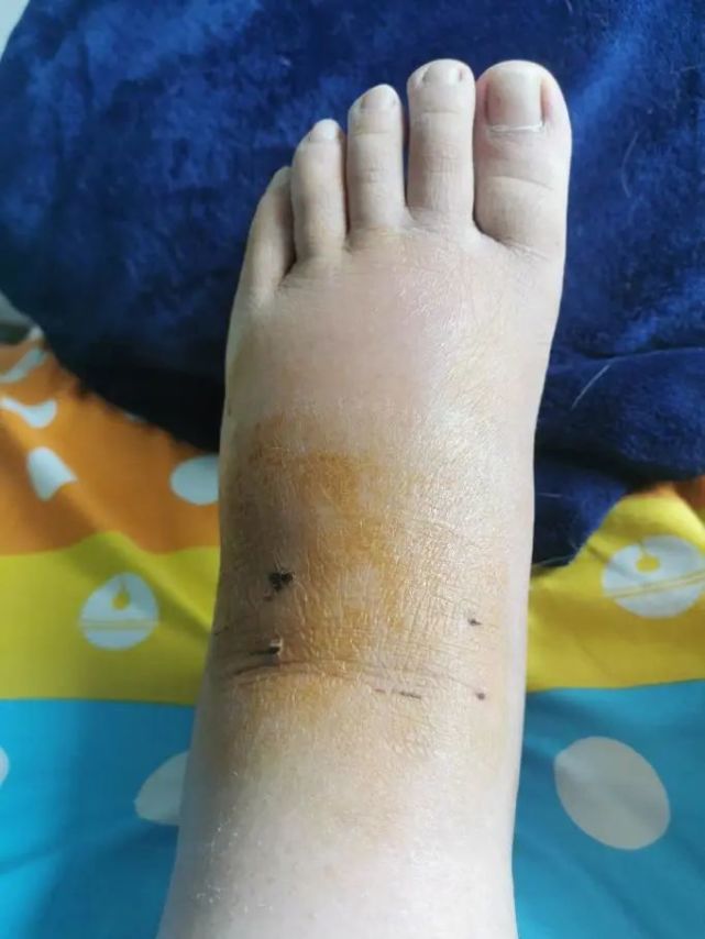 这脚已然肿成一颗饱满的葡萄一个熟透的西瓜一个灌满水的气球