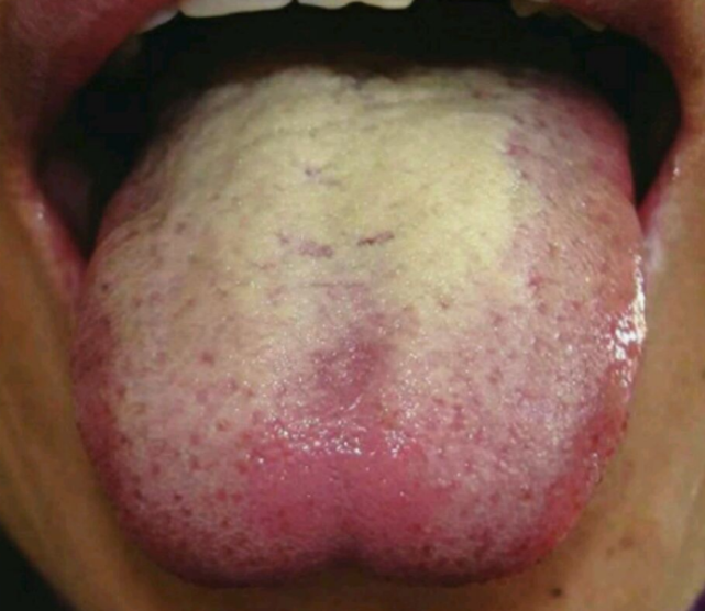 很多人都是不是明显可以看出他舌苔很是黄腻,这个就是说明体内有湿热