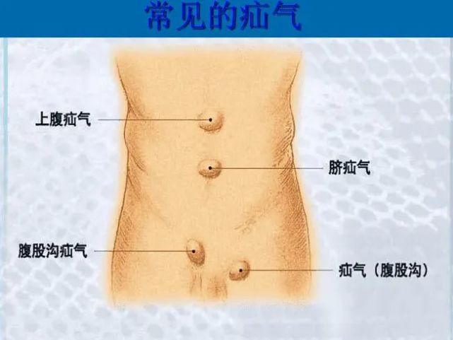 女人也得疝气!