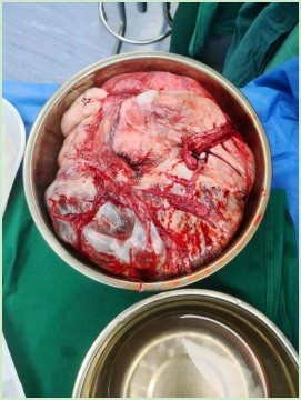 大肚子走进妇瘤中心多学科会诊保生命安全