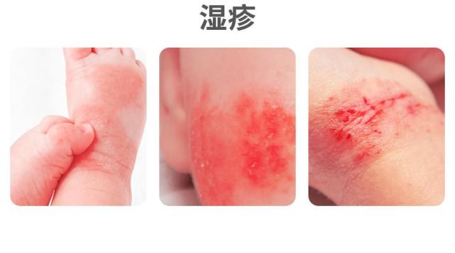 图片来源:图虫创意痱子一粒粒痱子有三种主要类型,包括晶疹,红疹和脓