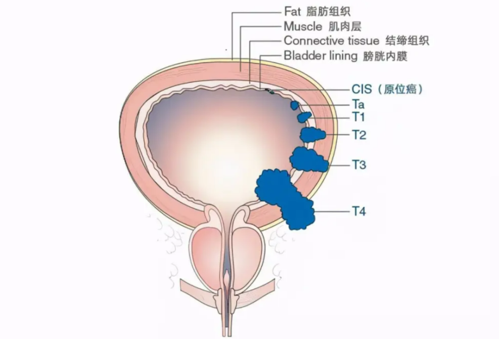 便血肠癌尿血膀胱癌咳血肺癌