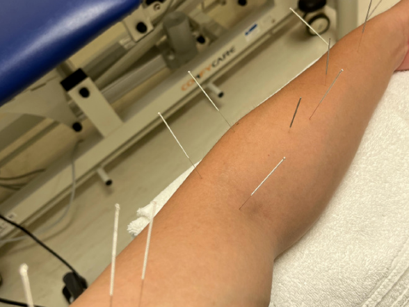 带娃太累苗苗月子期郑恺晒针灸照胳膊上扎数十根细针看着都疼