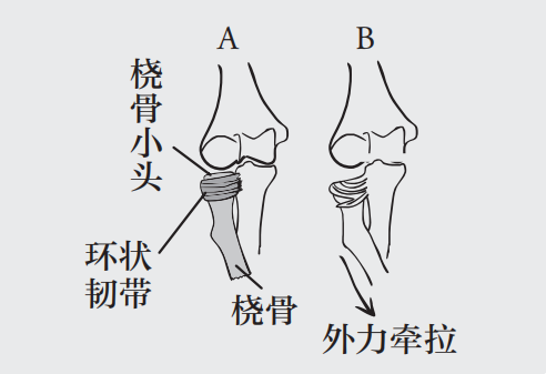 幼兒期的寶寶橈骨頭髮育尚未健全,環狀韌帶的結構也比較鬆弛,不能很好