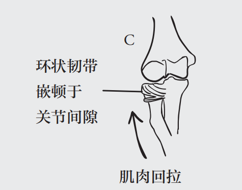 幼儿期的宝宝桡骨头发育尚未健全,环状韧带的结构也比较松弛,不能很好