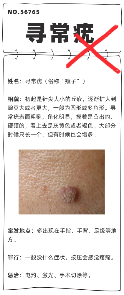 不要贴贴贴贴会传染得了皮肤疣一个传染俩